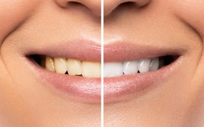 ¿Por qué mis dientes se han vuelto amarillos con los años?: Causas y soluciones