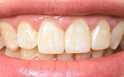 Qué son las manchas blancas en los dientes y cómo solucionarlas